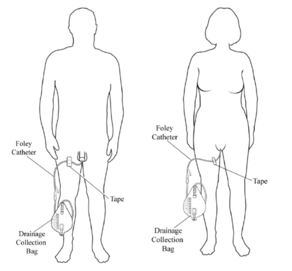 Urethral Indwelling Catheters image
